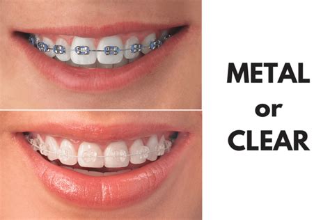 clear bracket braces vs metal|ceramic brackets vs metal.